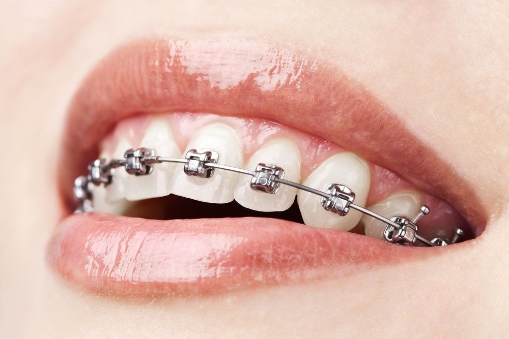Close-up of metal braces cost on teeth showing fixed orthodontic alignment system
