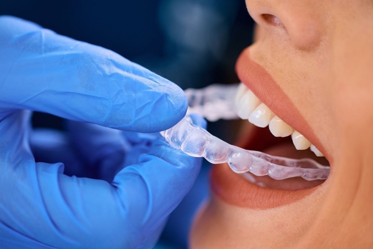 Dentist placing a clear Invisalign aligner on a patient’s teeth during orthodontic treatment in Abu Dhabi