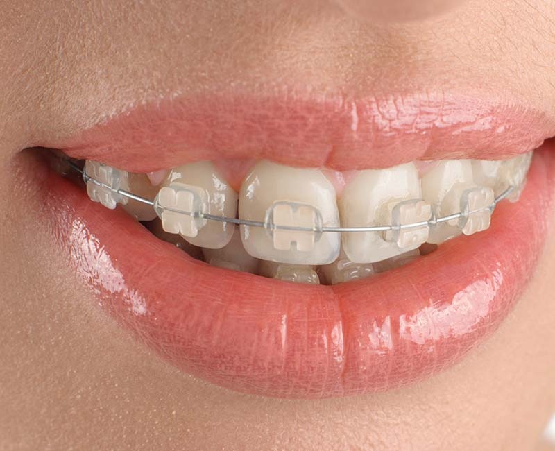 Clear orthodontic braces on teeth showing discreet teeth alignment treatment in Abu Dhabi