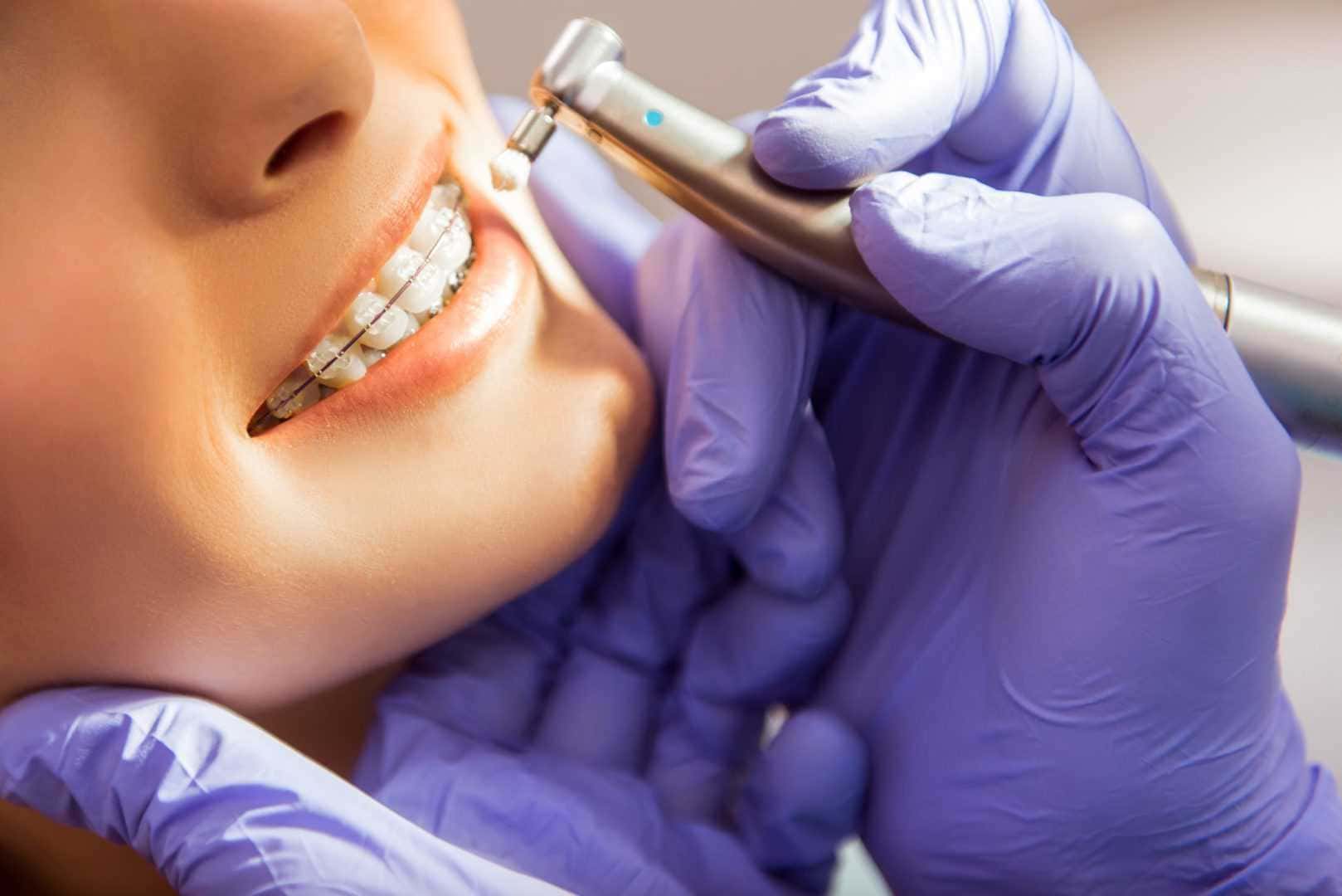 Dentist preparing teeth for Emax veneers using professional dental tools.