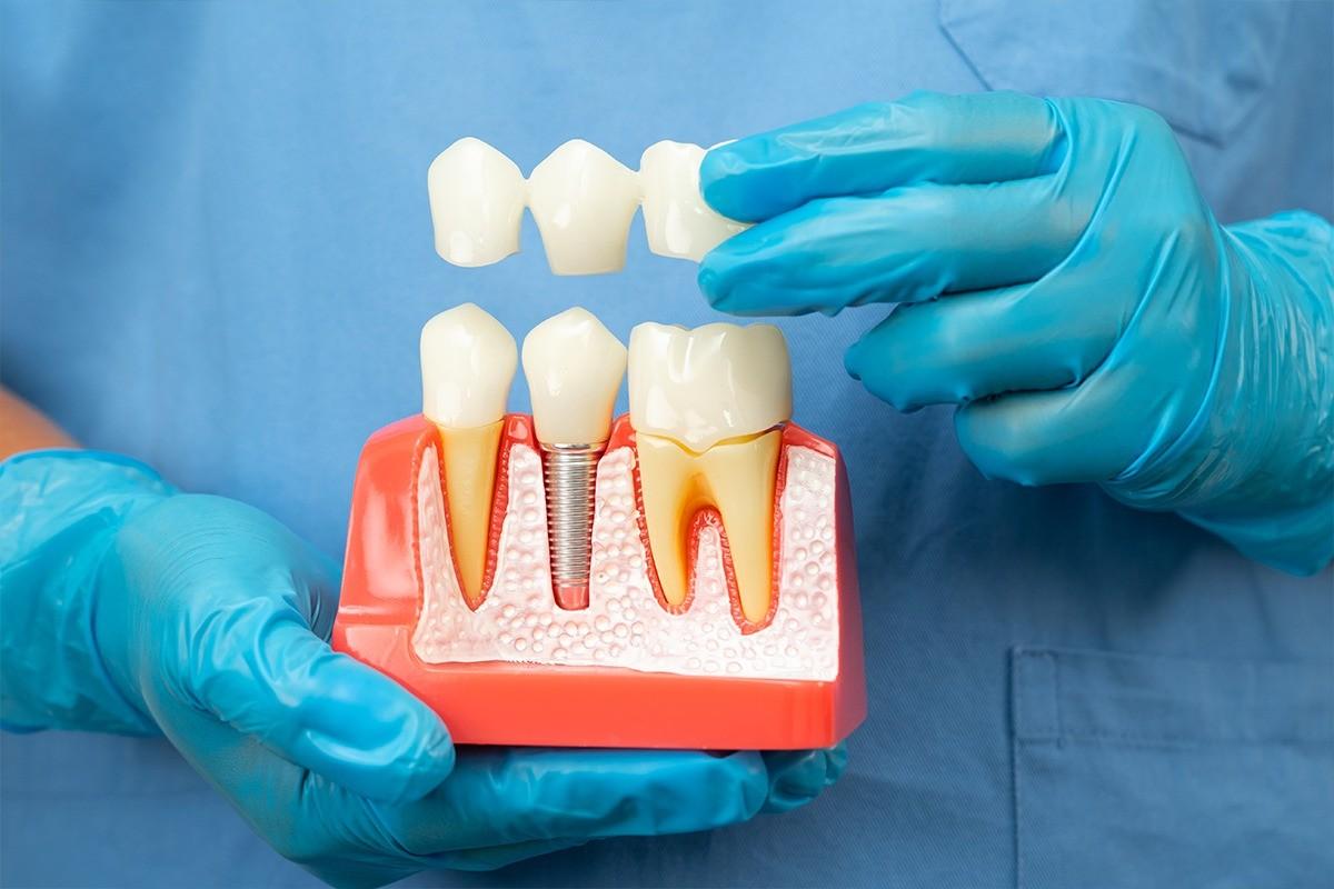 Dental model illustrating different tooth restoration options, including dental fillings and crowns, held by a dentist for treatment planning explanation