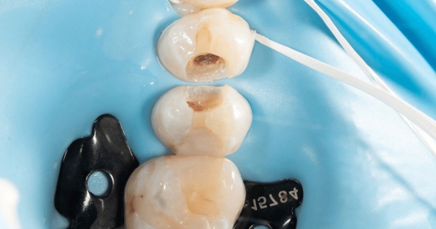 Close-up view of tooth cavities prepared for dental fillings under rubber dam isolation during restorative treatment