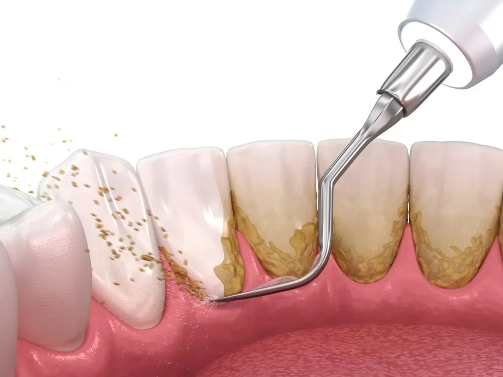 Illustration of teeth scaling removing plaque and tartar from the gum line.