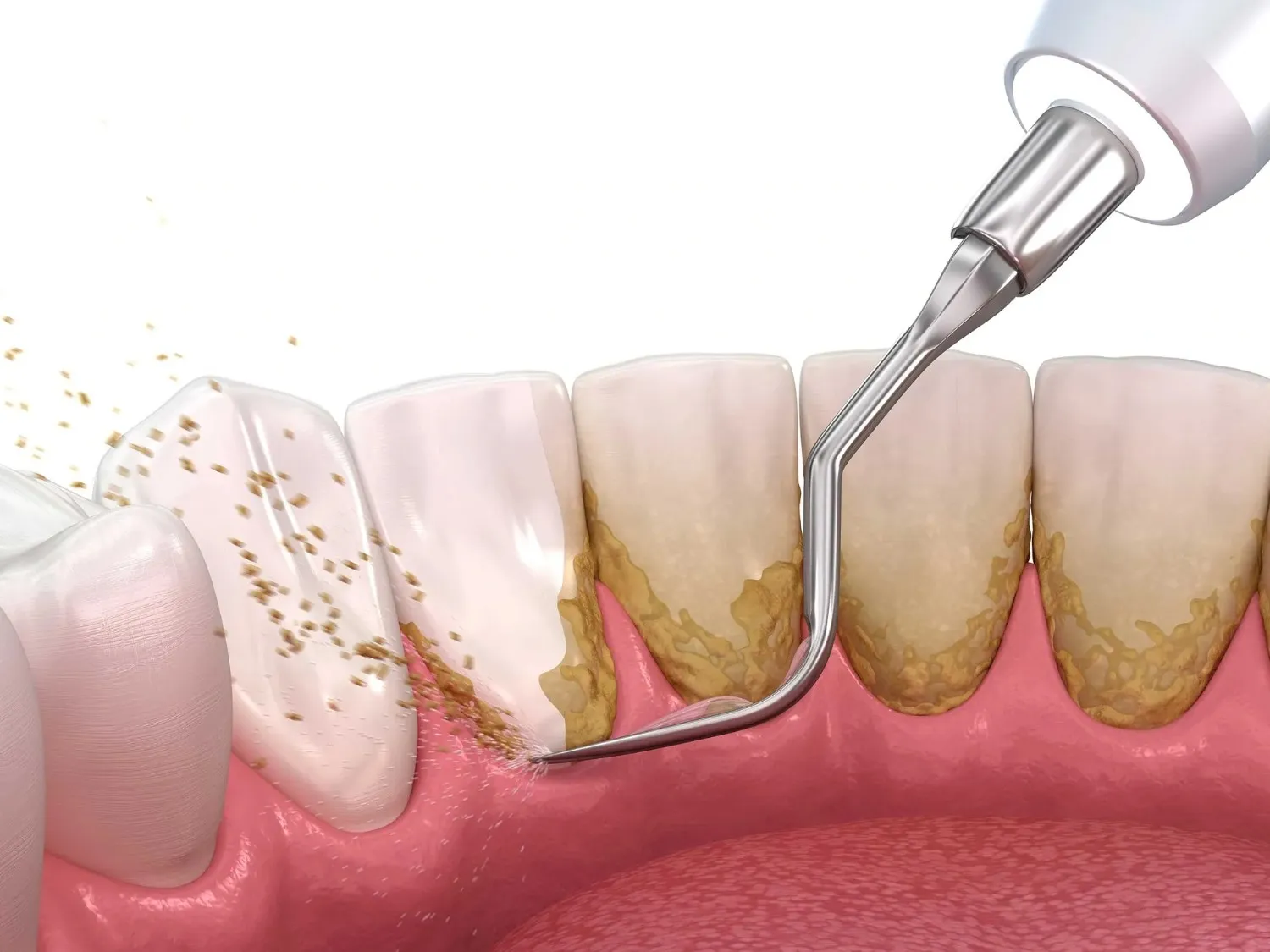 Illustration of teeth scaling removing plaque and tartar from the gum line.