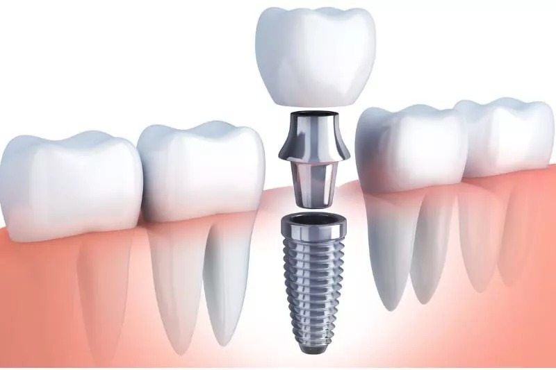 3D illustration of a dental implant structure showing the implant screw, abutment, and crown placement in the jawbone.