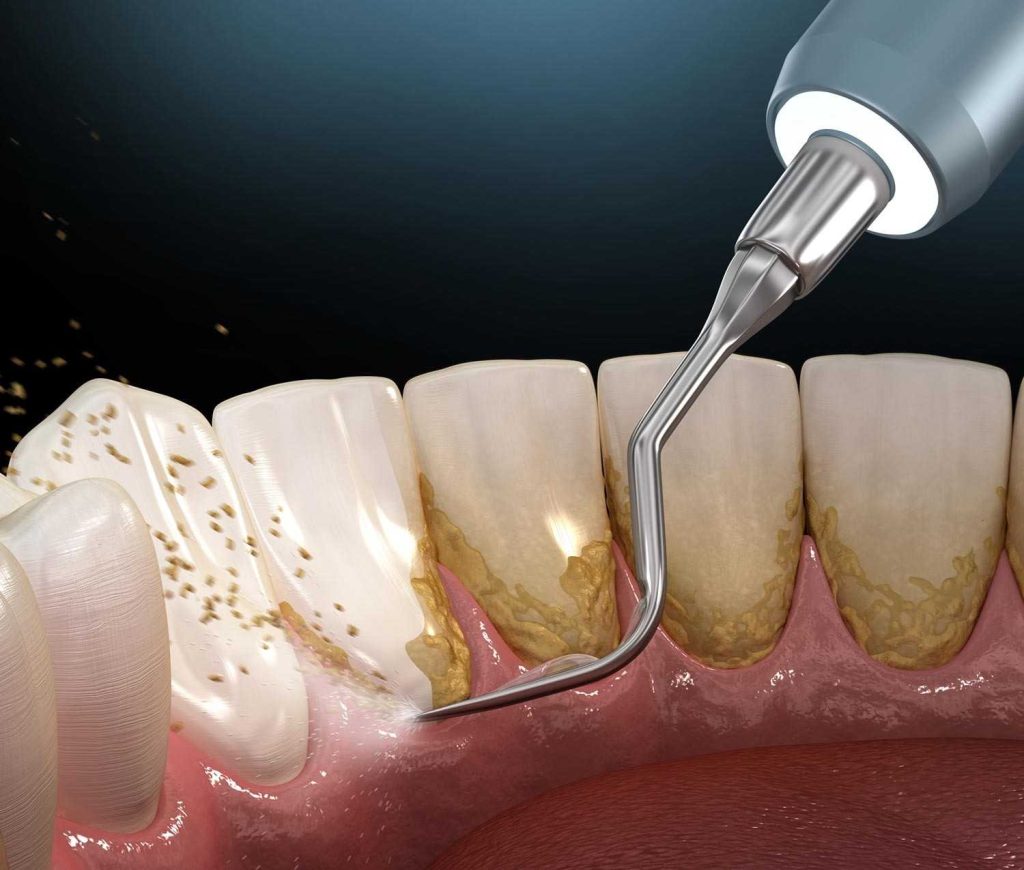 Illustration of tartar removal around the teeth and below the gum line using a professional scaling device.