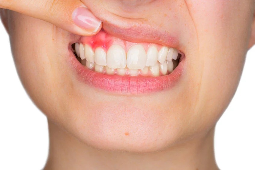Inflamed and red upper gum tissue around the front teeth indicating signs of gum disease in a Gum treatment cost article