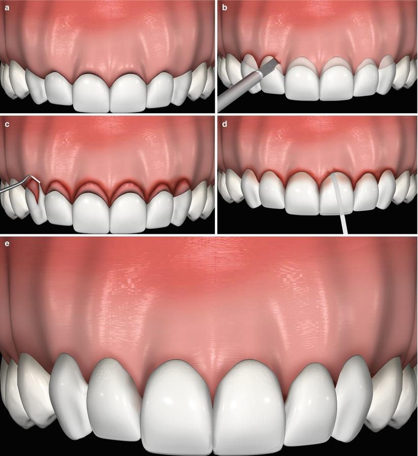 Diagram illustrating the stages of gum recession treatment and gum line correction around the front teeth.