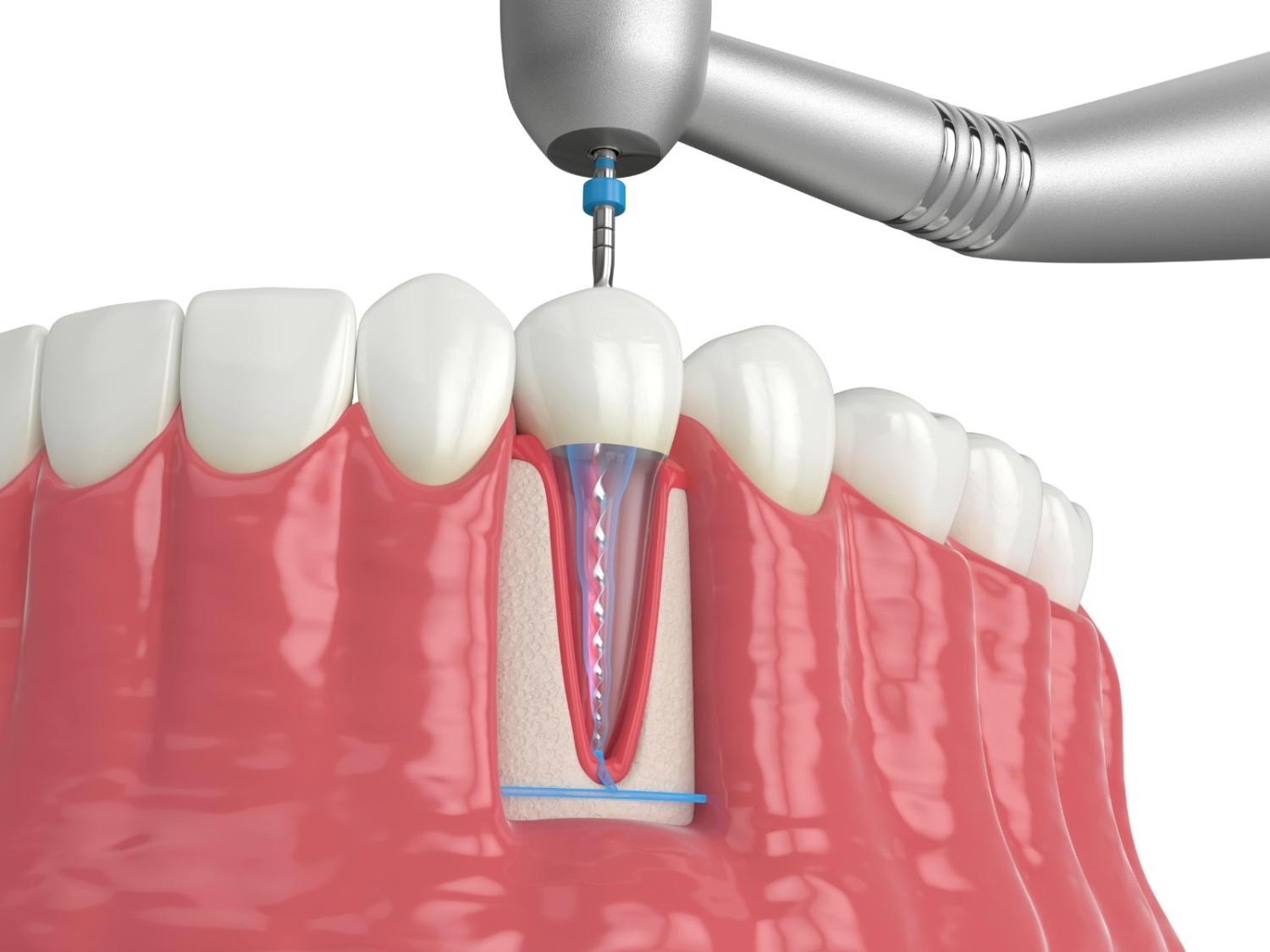 3D illustration of a root canal treatment procedure showing the cleaning and shaping of infected tooth pulp with a dental instrument, visually supporting information about root canal cost and what the procedure involves.