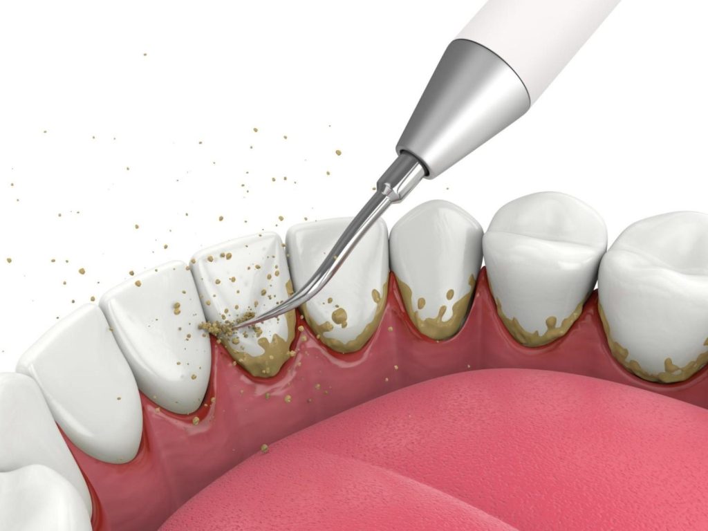 Medical diagram showing the removal of plaque and tartar from teeth using a scaling instrument during professional dental cleaning