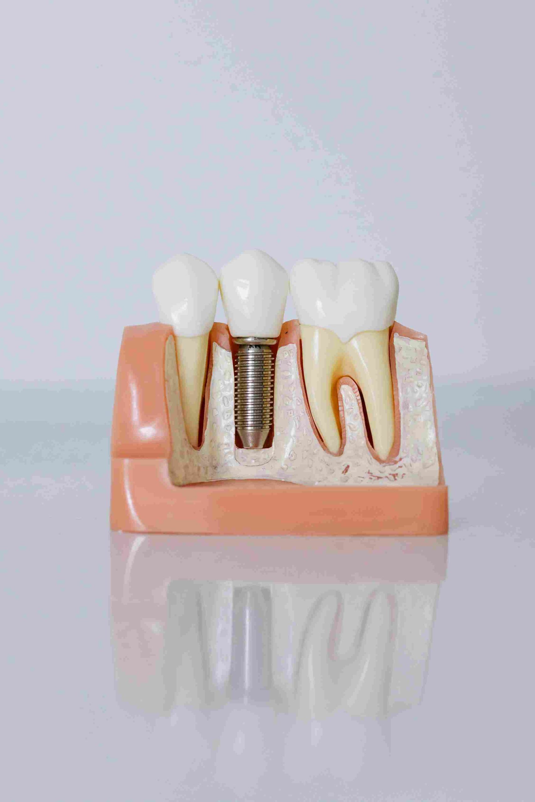 dental implants Abu Dhabi