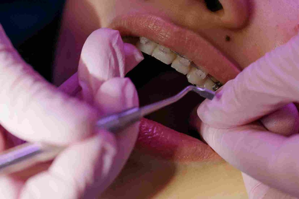 ceramic braces Abu Dhabi